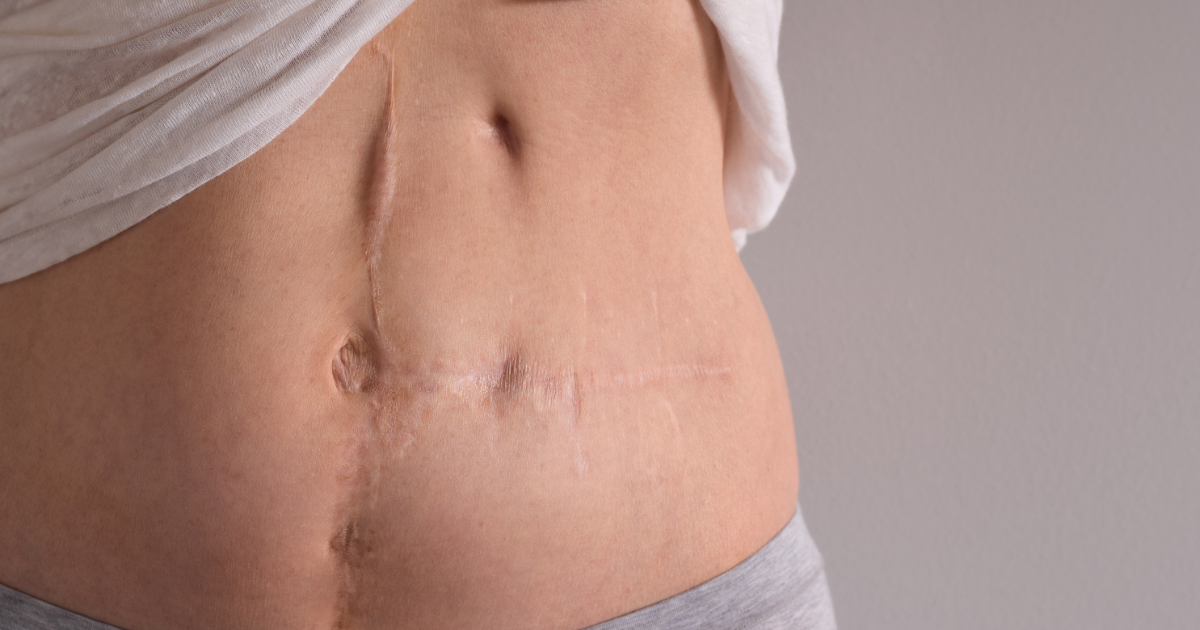 Woman's abdomen with scars