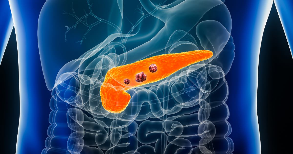 Medical illustration of pancreatic cancer