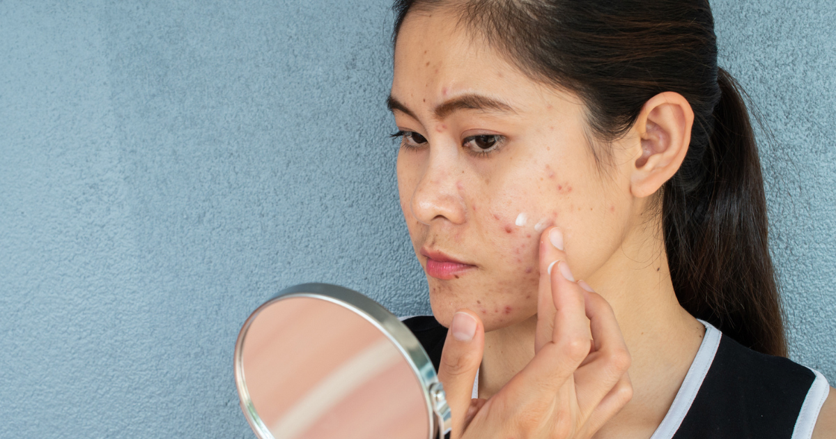 Woman applying acne cream