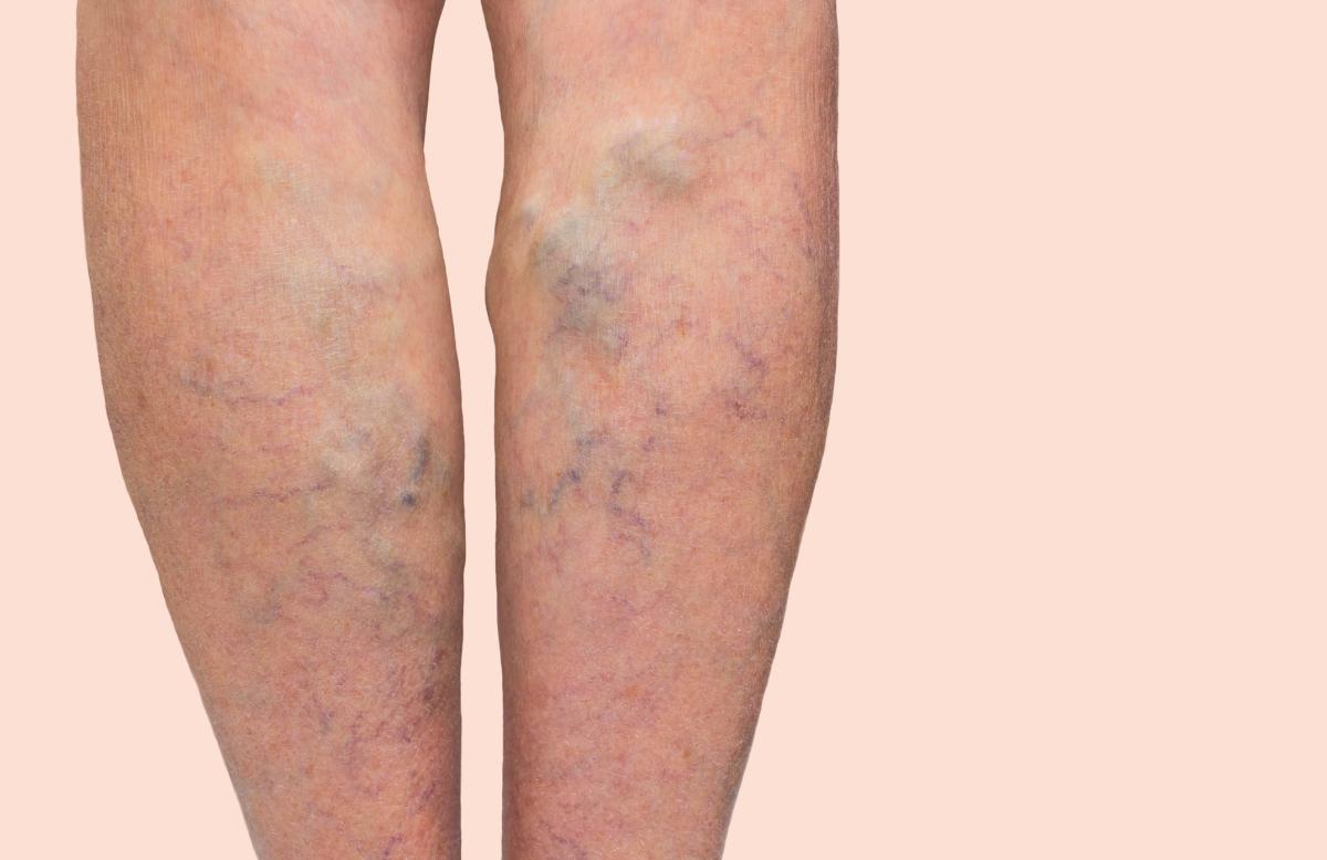 Woman's legs with varicose veins