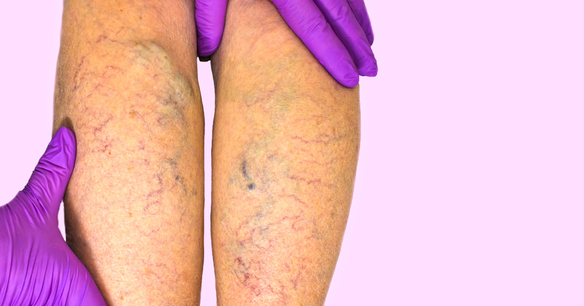 legs with varicose veins