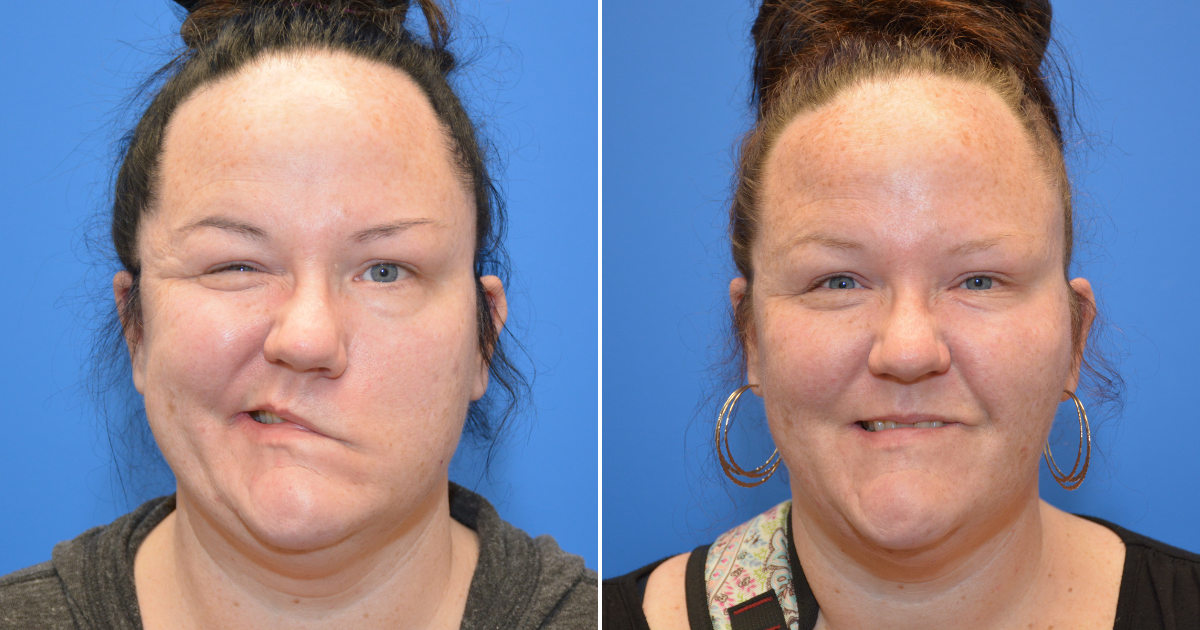 Patient Mandy Gartner before and after facial paralysis surgery