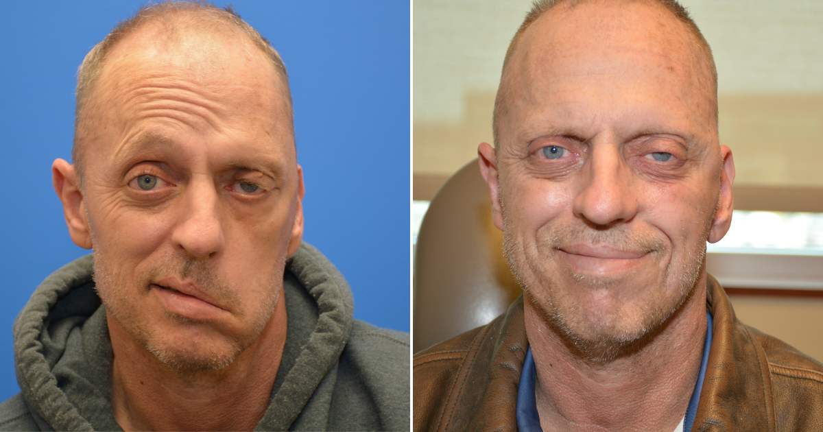 Patient Kenneth Koch before and after facial paralysis surgery