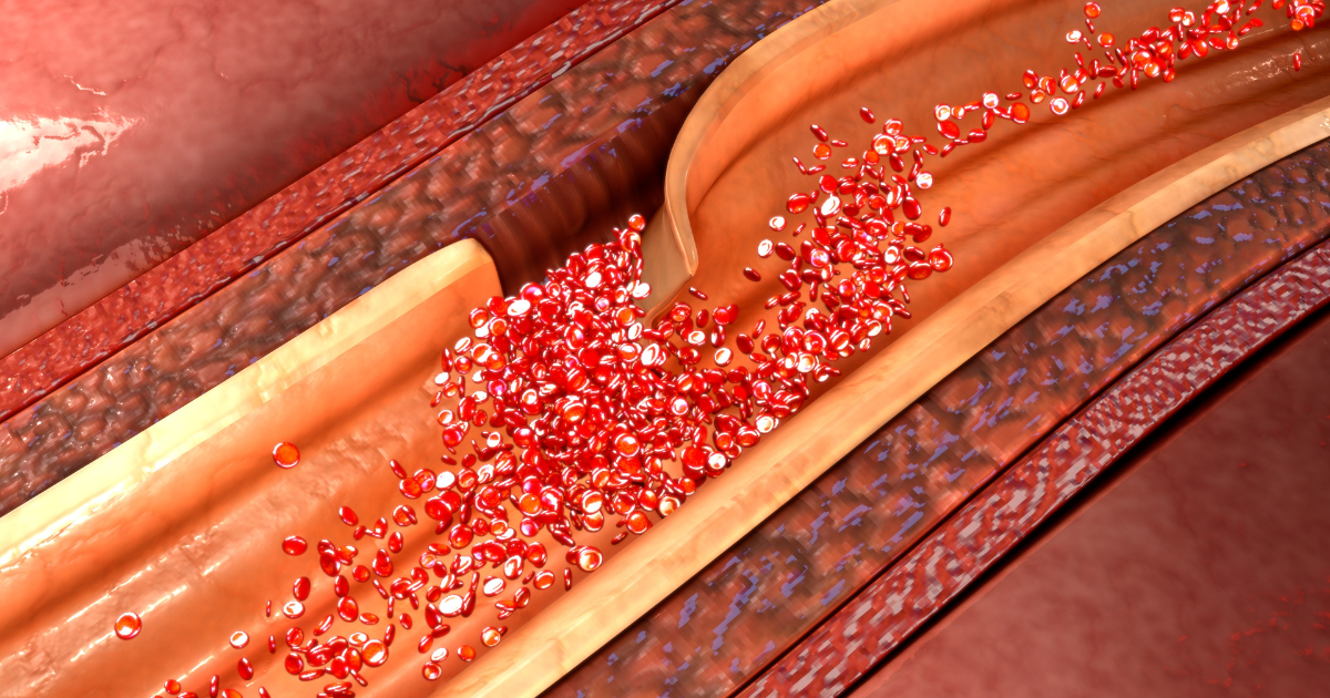 Medical illustration of aortic dissection