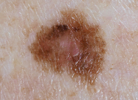 Image of a mole
