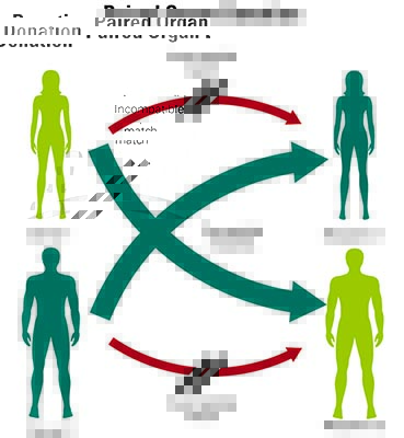 Illustration of how paired living organ donation works