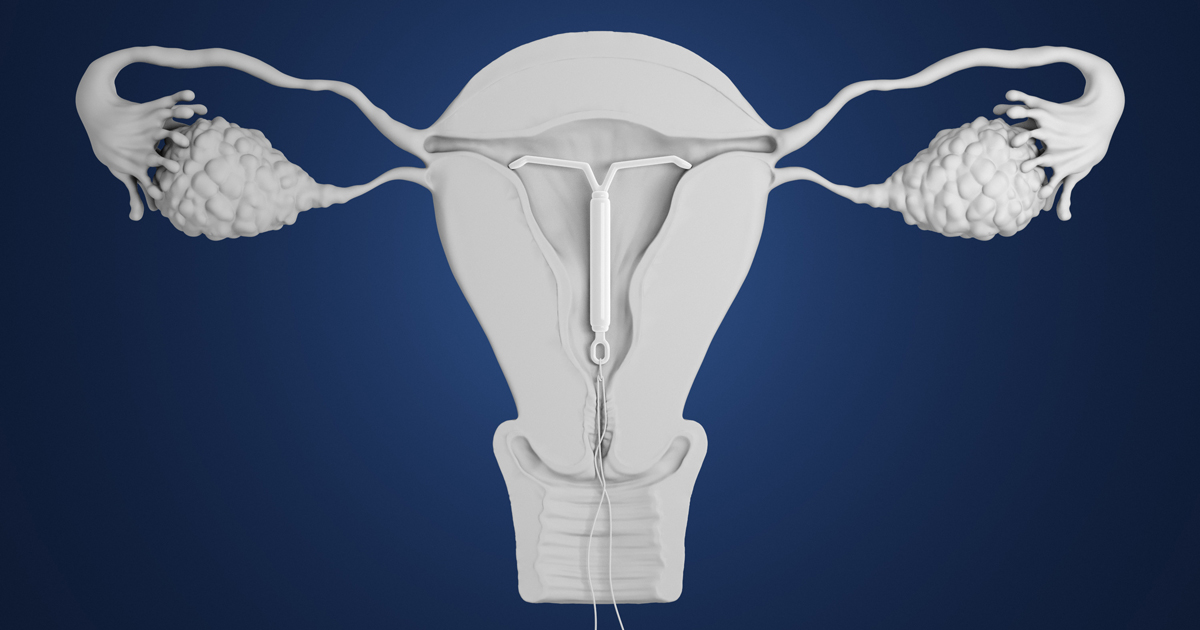 Medical illustration of the female reproductive system with an IUD