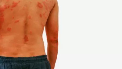 Man with a rash on his back