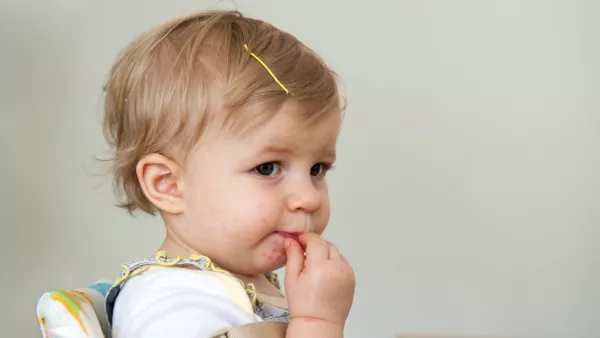 Young girl with hand, foot and mouth disease