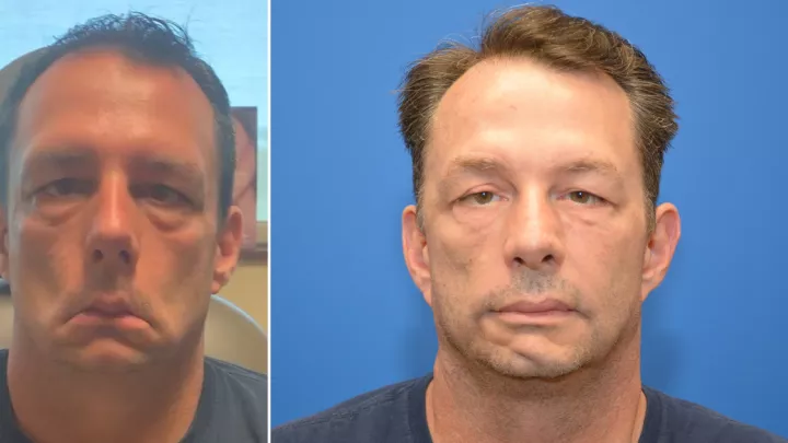 Barry Conner before and after facial paralysis surgery