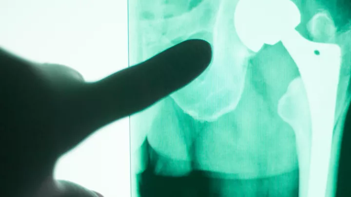Finger pointing at x-ray