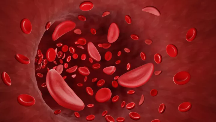 Medical illustration of a sickle cell