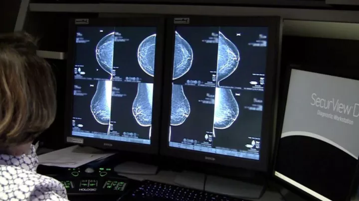 3D mammogram