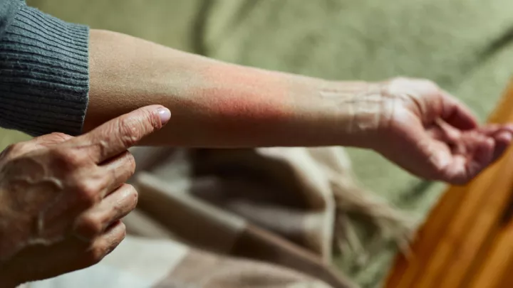 Close up of woman's arm with a rash