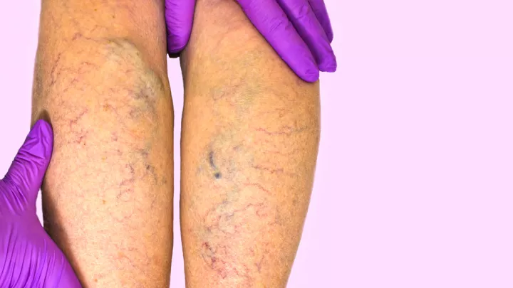 legs with varicose veins