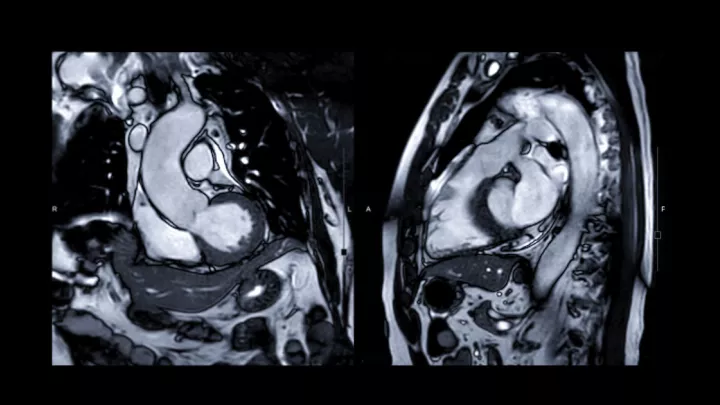 Cardiac MRI image